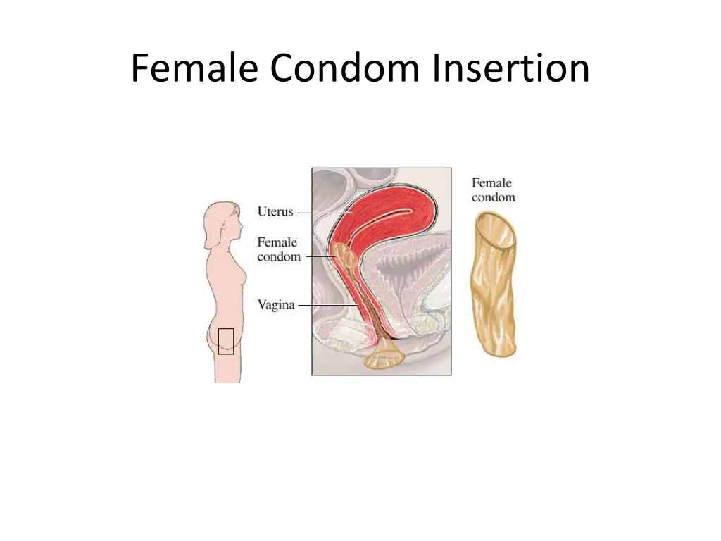female condom insertion