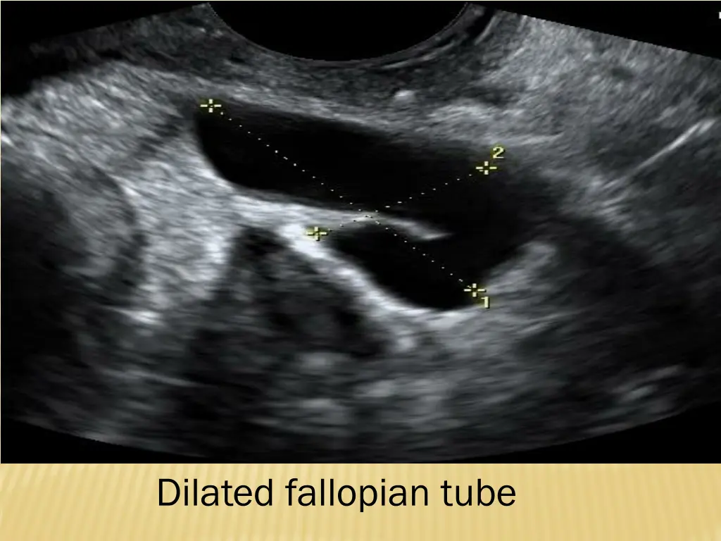 dilated fallopian tube