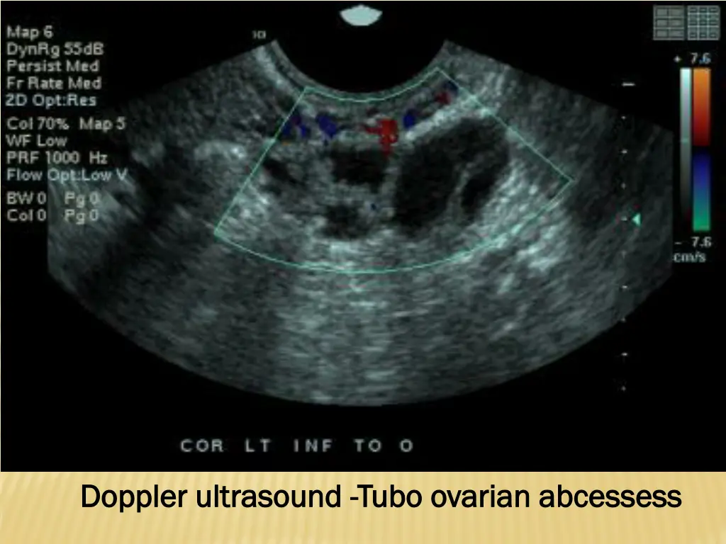 doppler ultrasound doppler ultrasound tubo
