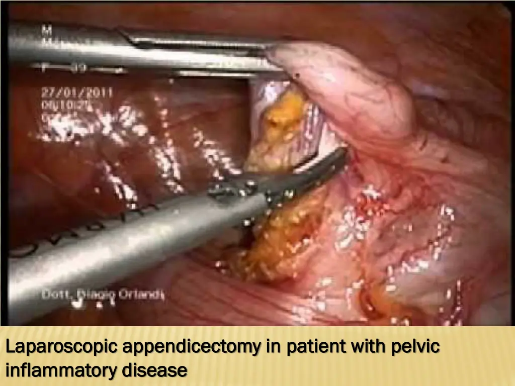 laparoscopic laparoscopic appendicectomy