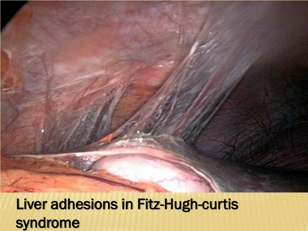 liver adhesions in fitz liver adhesions in fitz