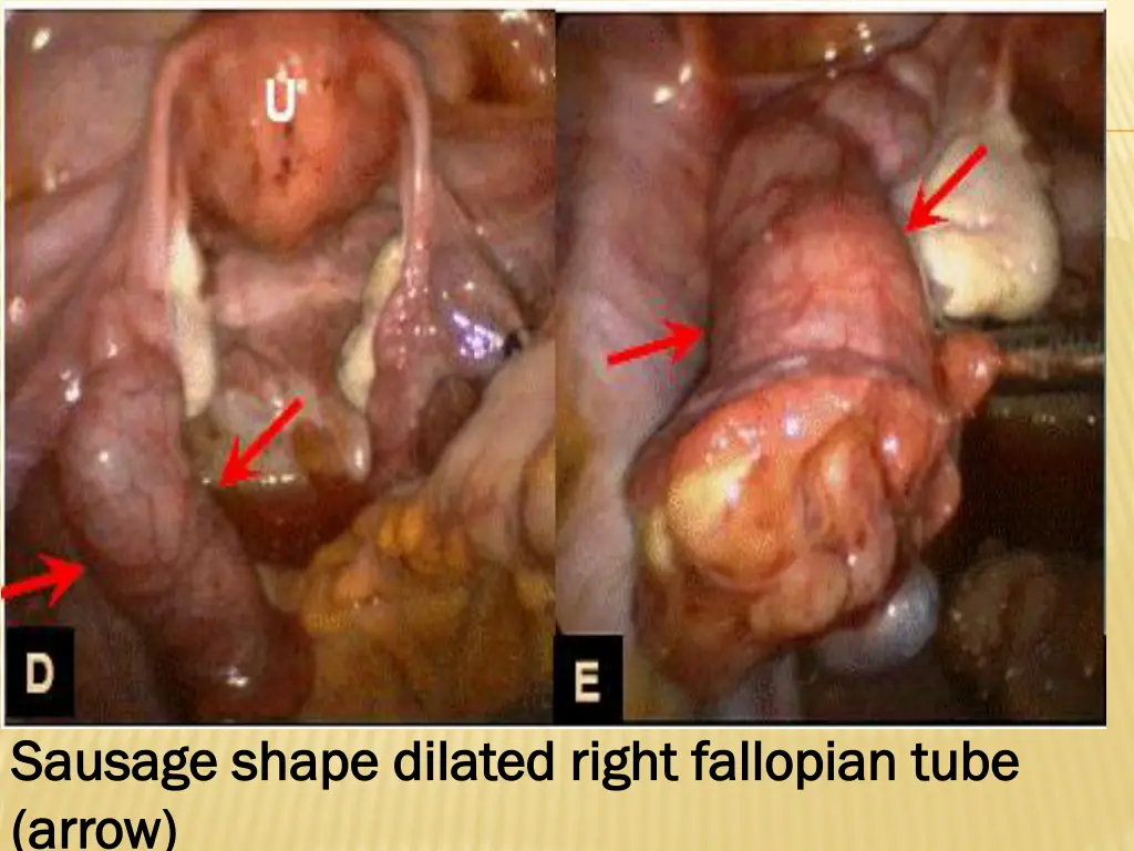 sausage shape dilated right fallopian tube