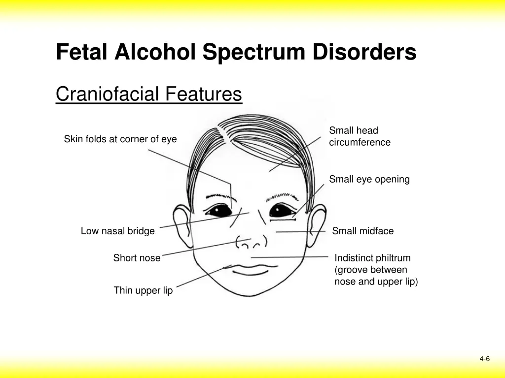 fetal alcohol spectrum disorders 2