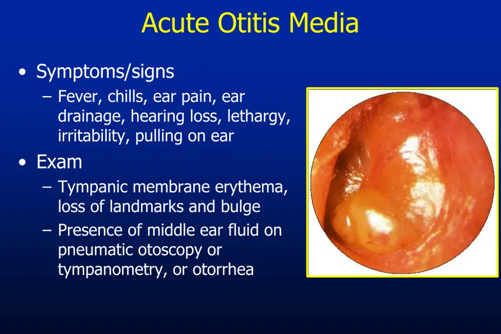 acute otitis media 2