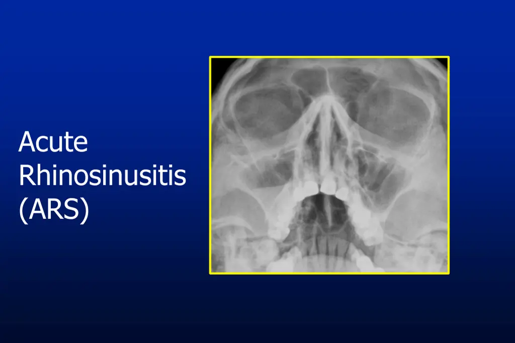 acute rhinosinusitis ars