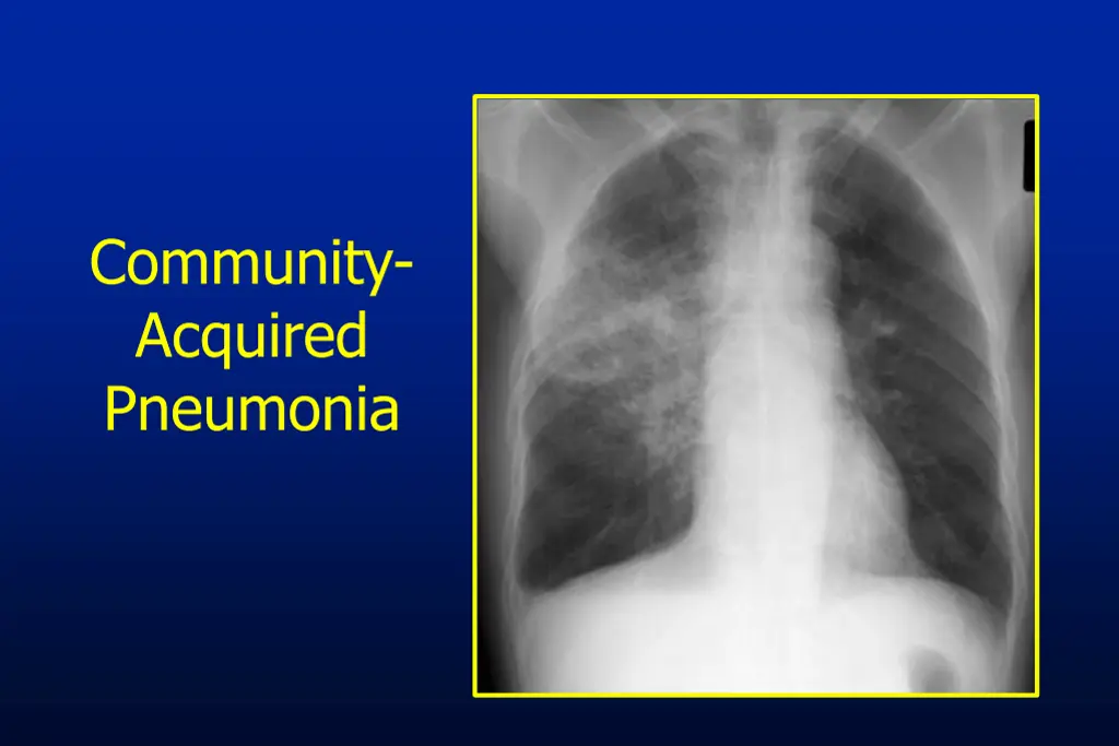 community acquired pneumonia