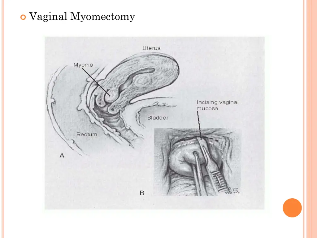 vaginal myomectomy