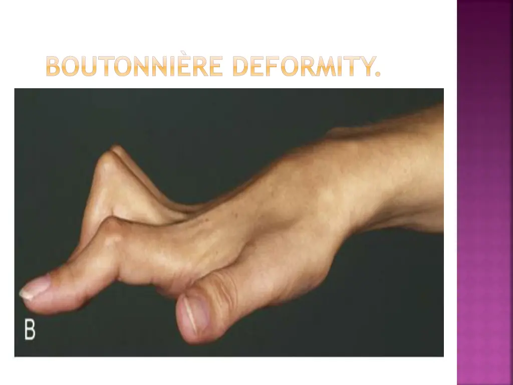 boutonni re deformity