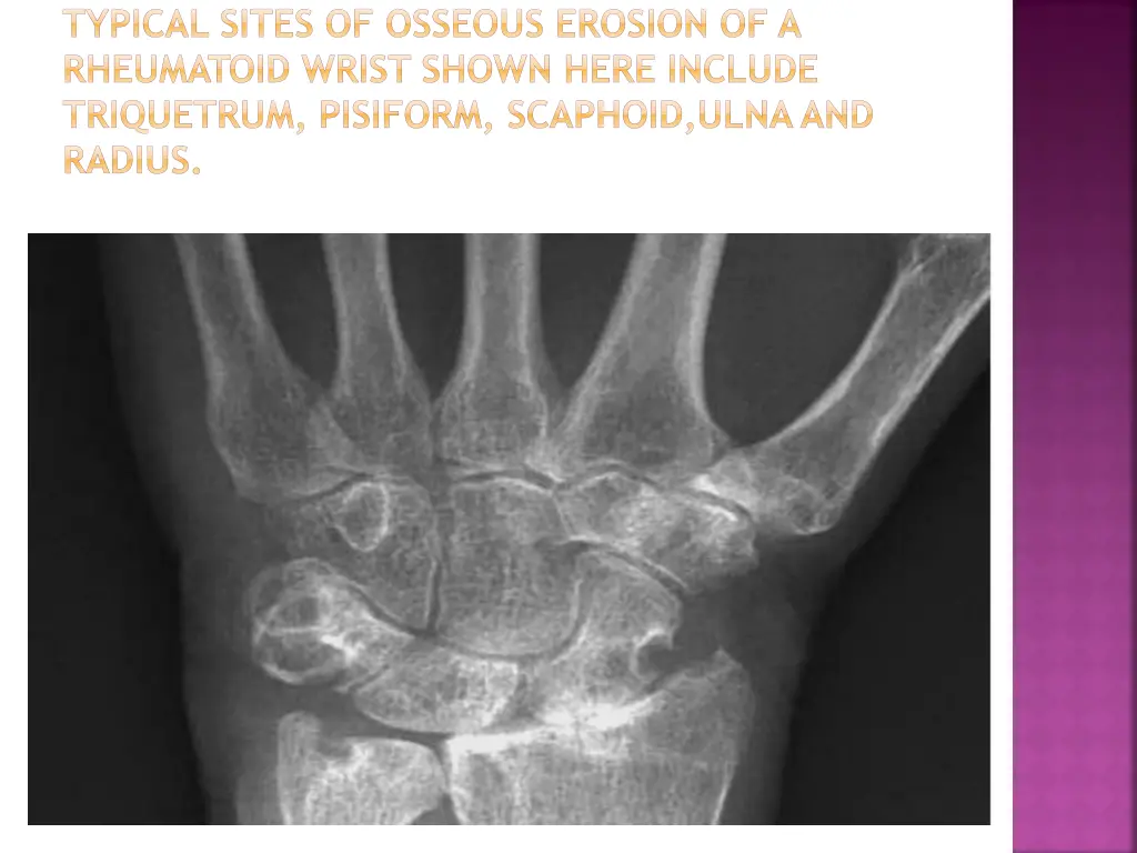 typical sites of osseous erosion of a rheumatoid