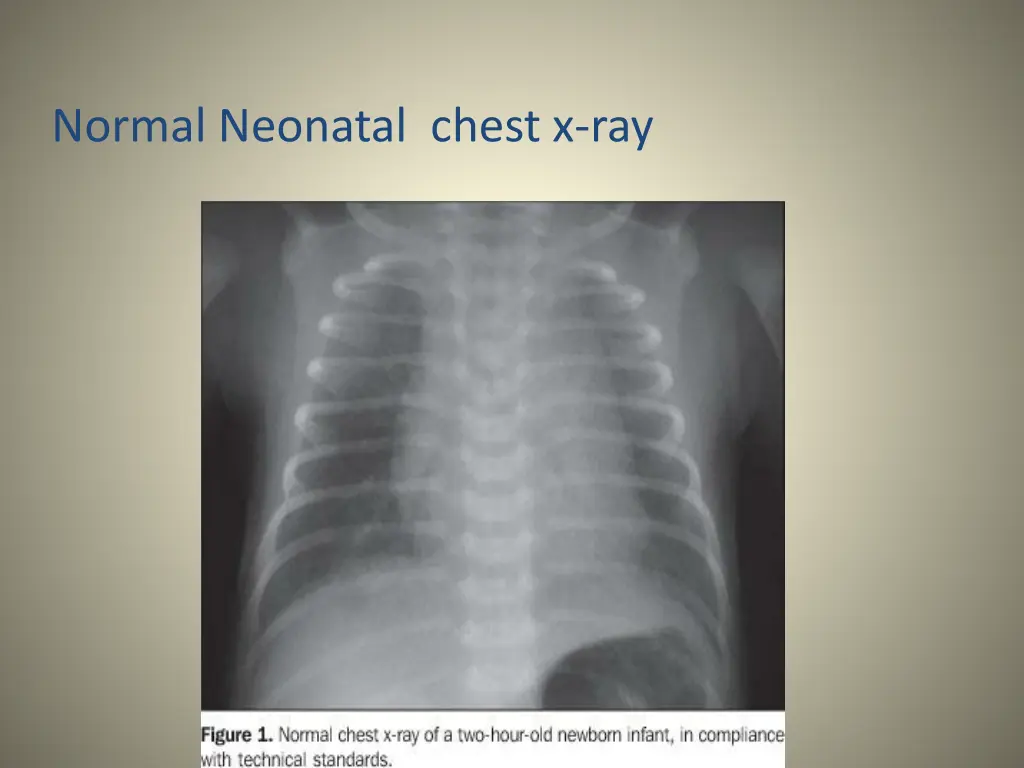 normal neonatal chest x ray