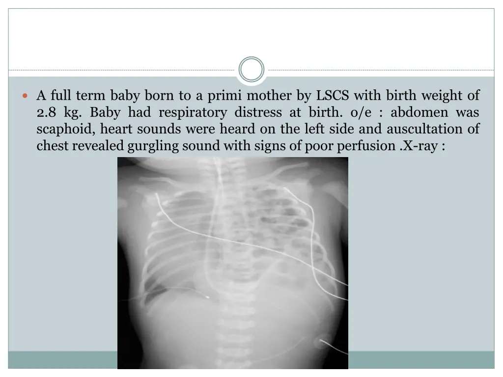 a full term baby born to a primi mother by lscs