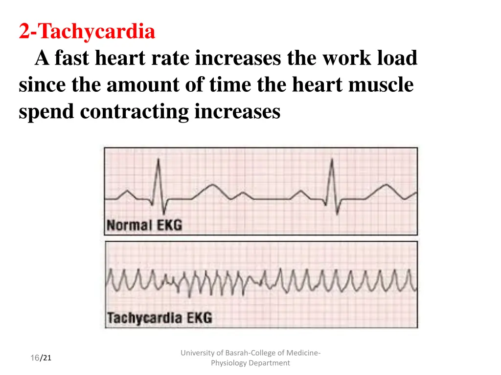 2 tachycardia a fast heart rate increases