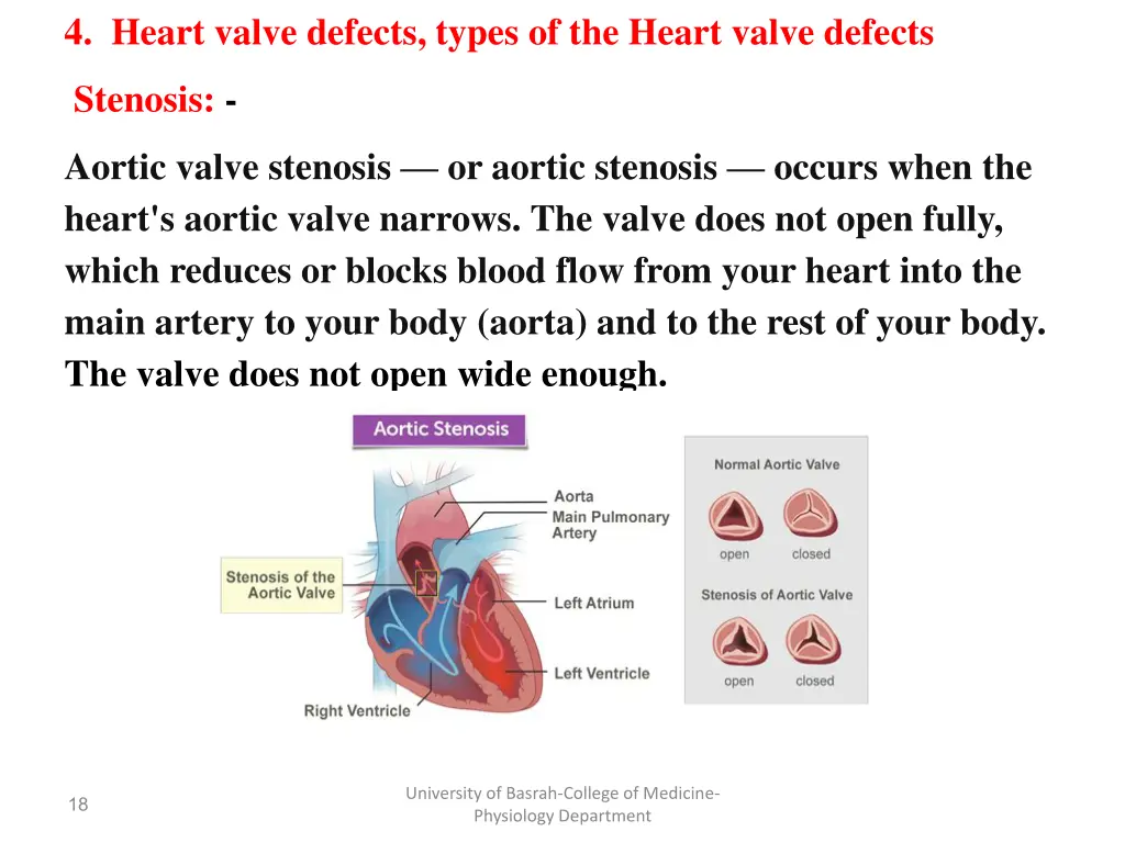 4 heart valve defects types of the heart valve