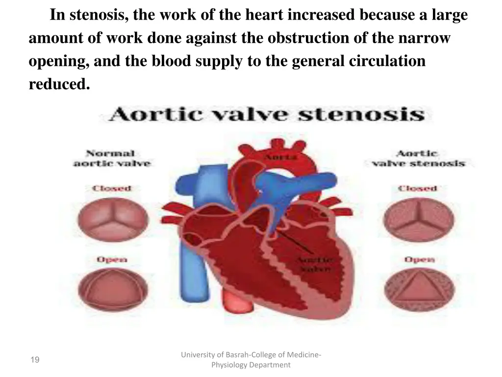 in stenosis the work of the heart increased