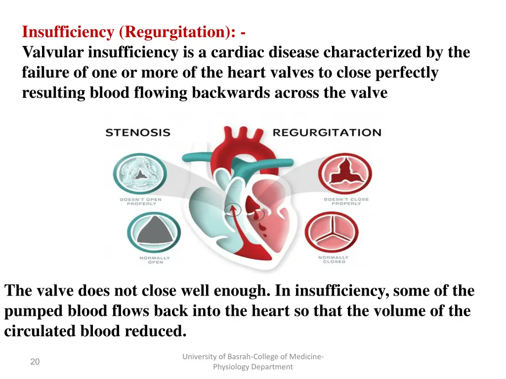 insufficiency regurgitation valvular