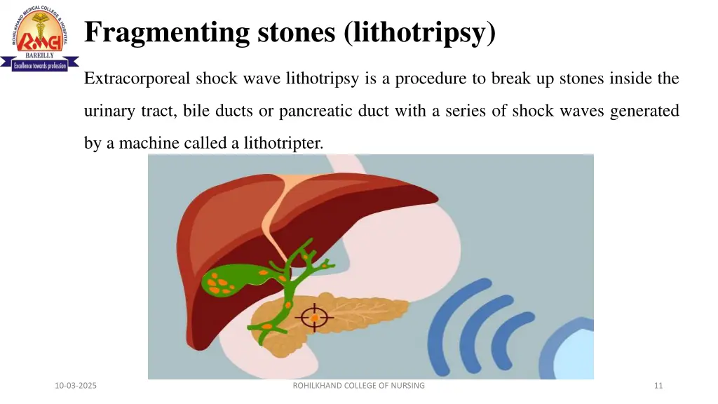 fragmenting stones lithotripsy