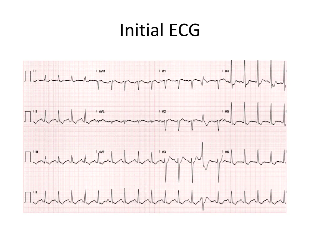initial ecg