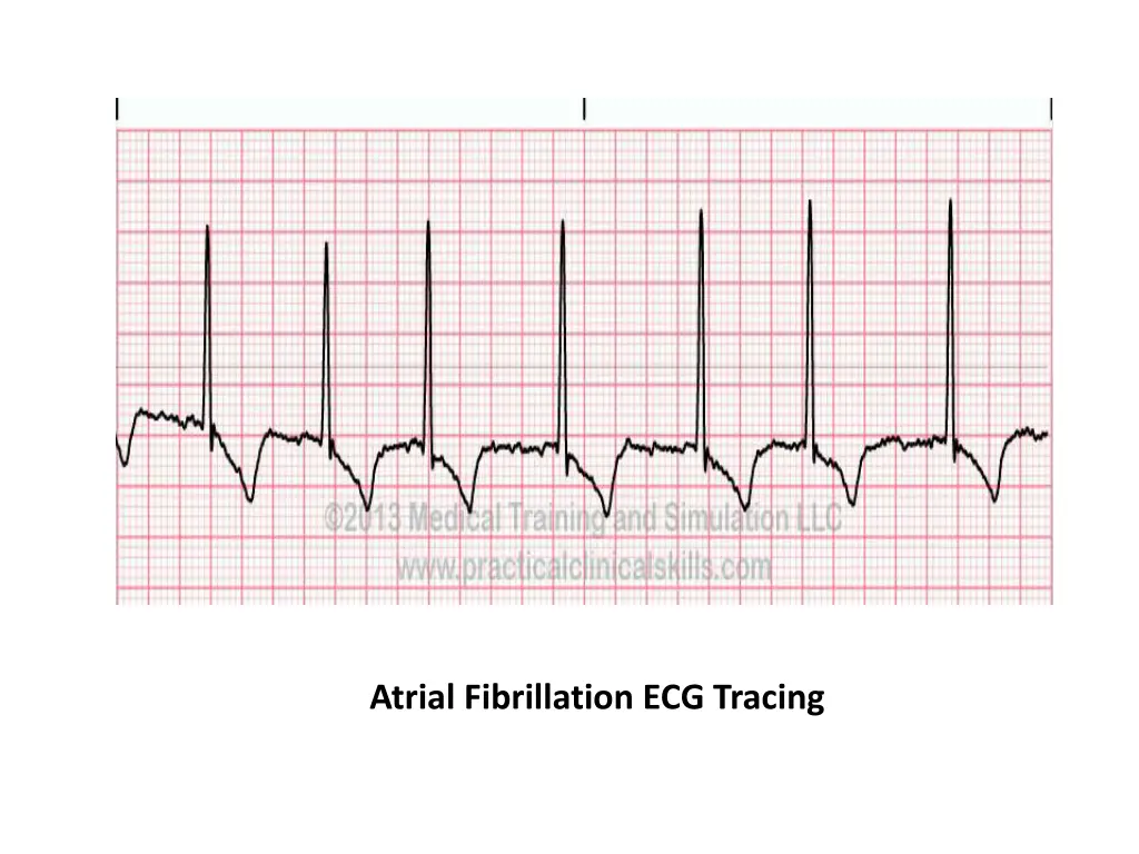 atrial fibrillation ecg tracing