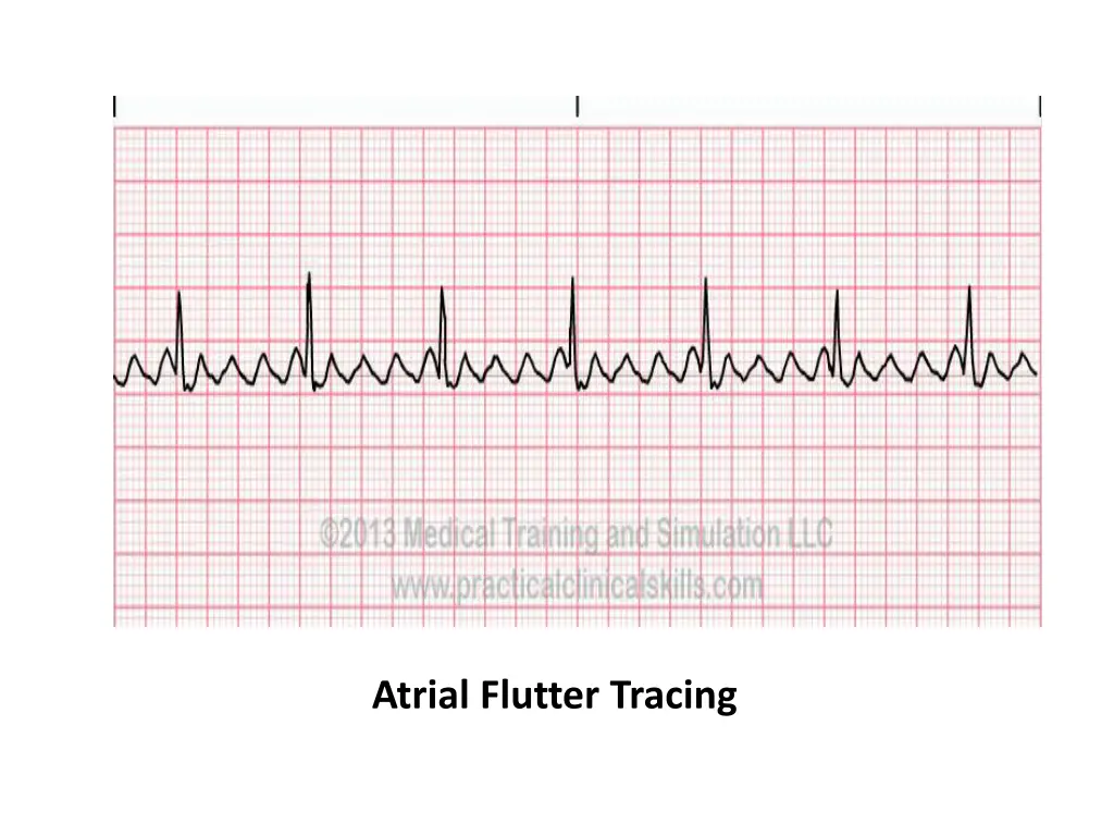 atrial flutter tracing