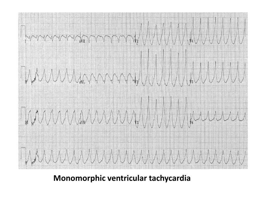 monomorphic ventricular tachycardia