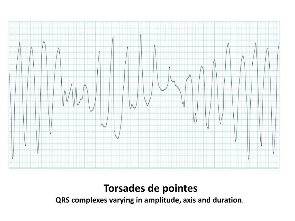 torsades de pointes