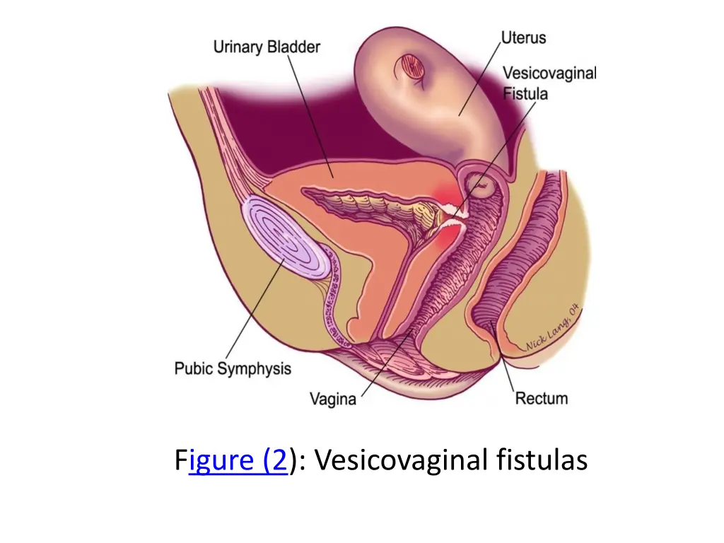 figure 2 vesicovaginal fistulas