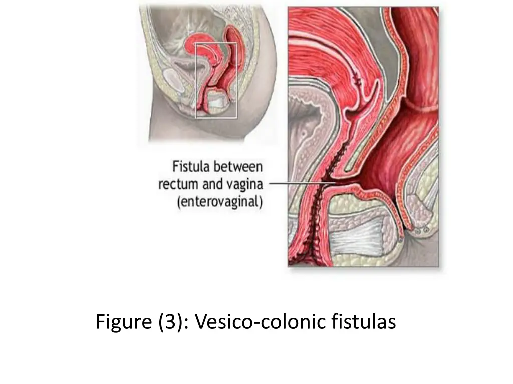 figure 3 vesico colonic fistulas