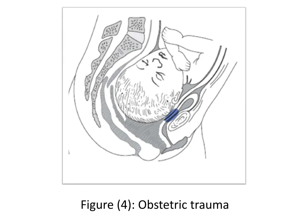 figure 4 obstetric trauma