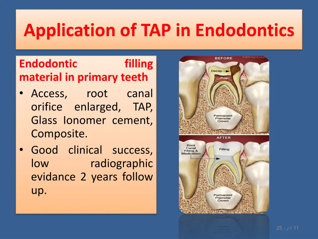 application of tap in endodontics 1