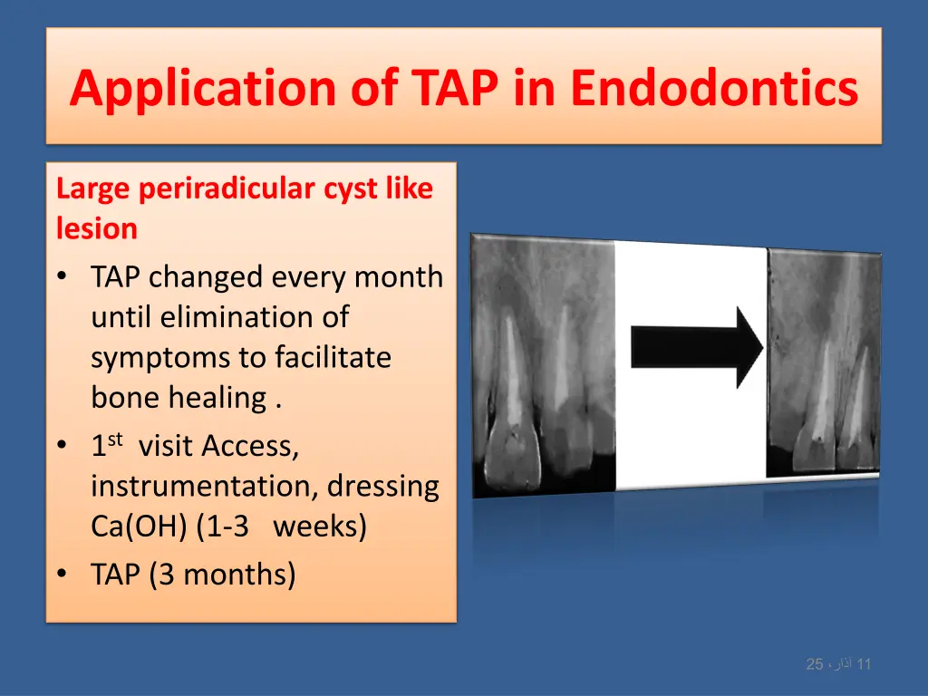 application of tap in endodontics