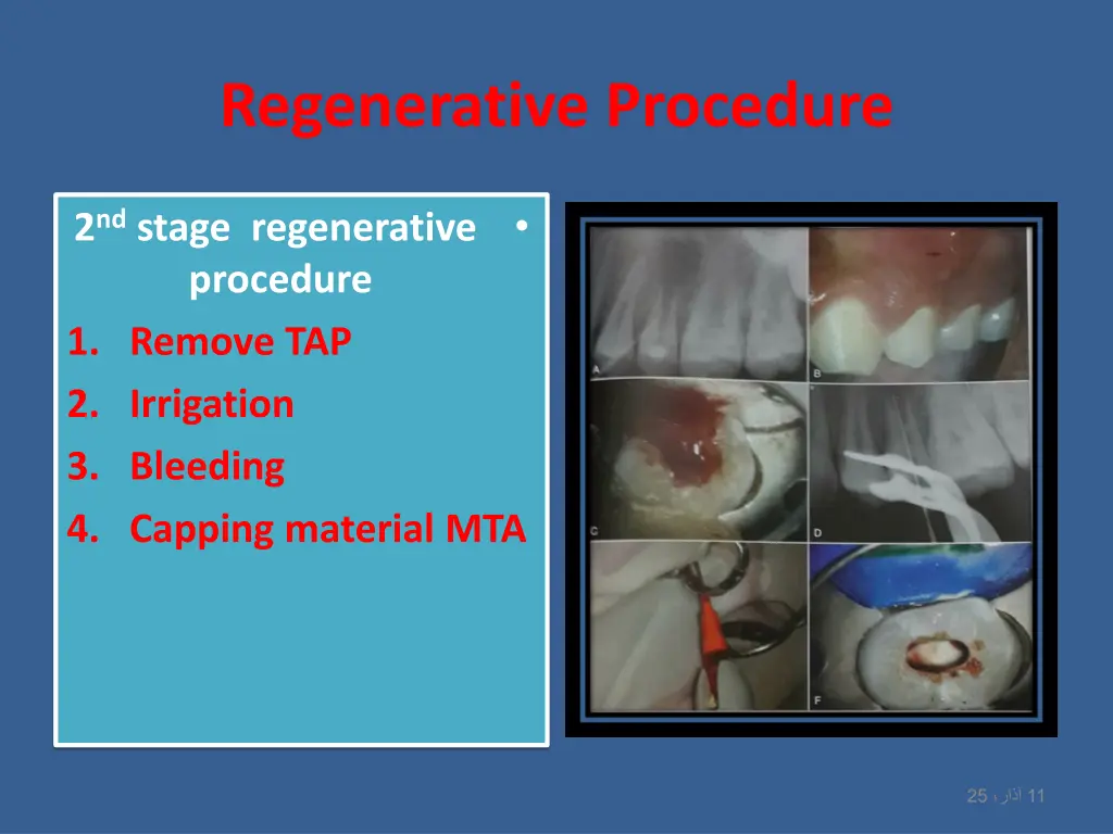regenerative procedure 1