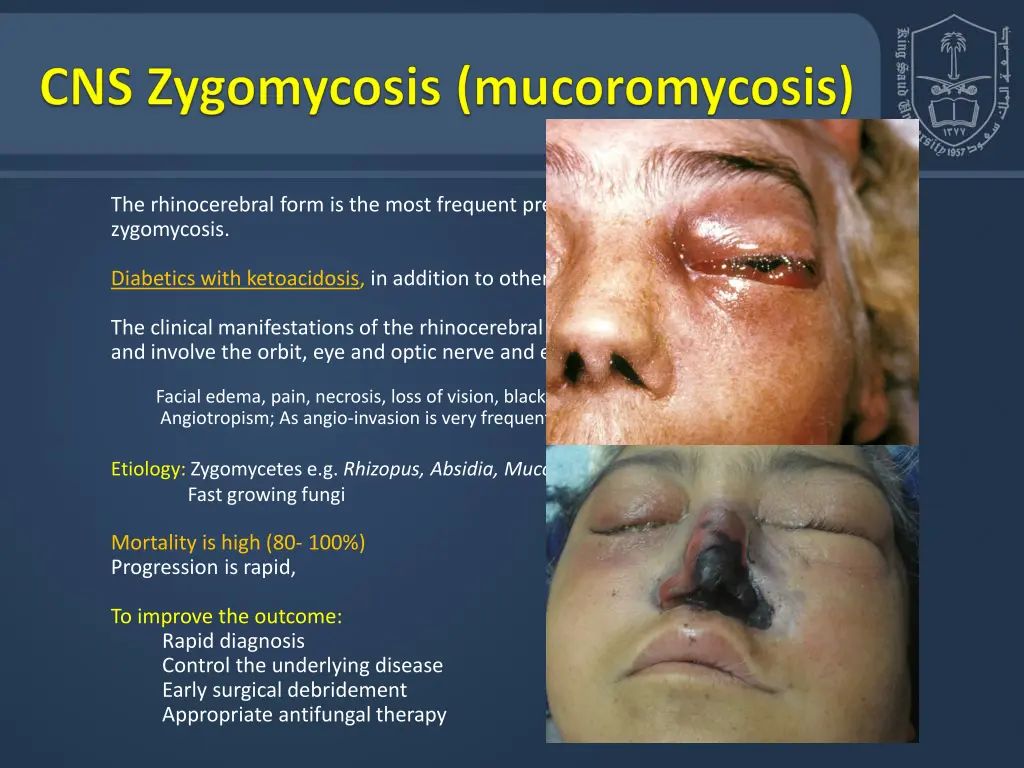 the rhinocerebral form is the most frequent