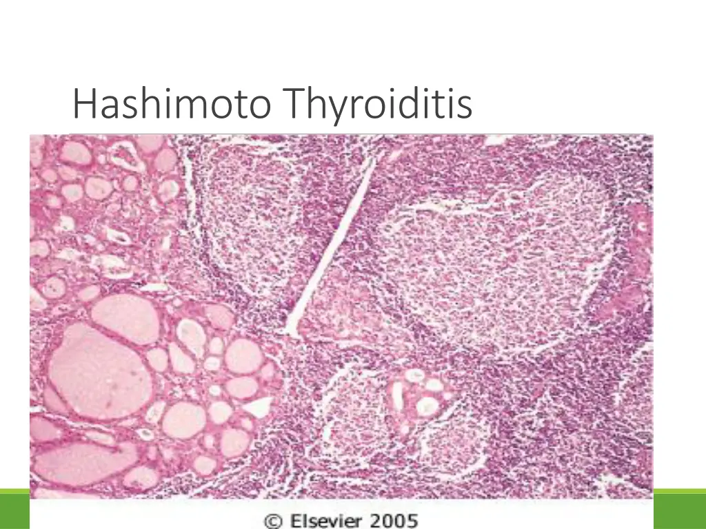 hashimoto thyroiditis 1