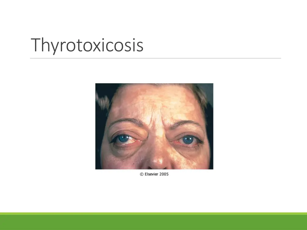 thyrotoxicosis 1