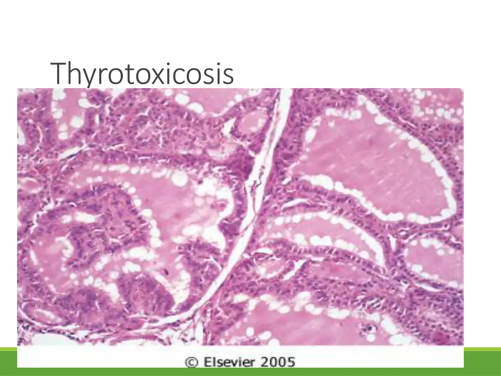 thyrotoxicosis 2