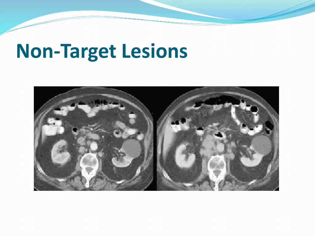non target lesions 2