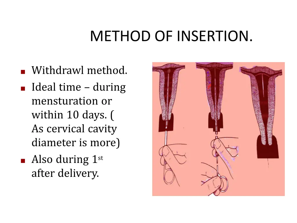 method of insertion