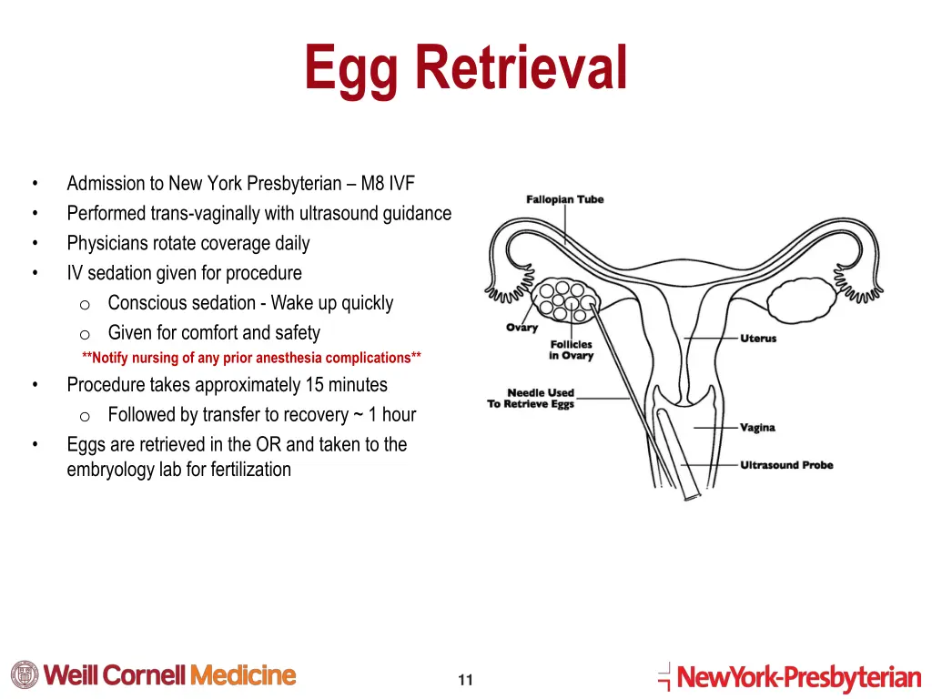 egg retrieval