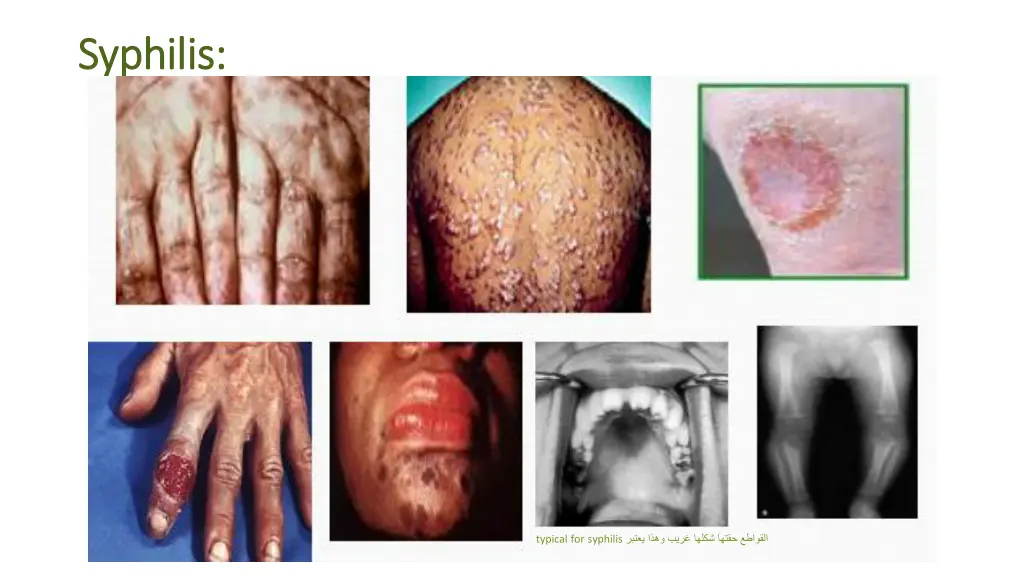 syphilis syphilis