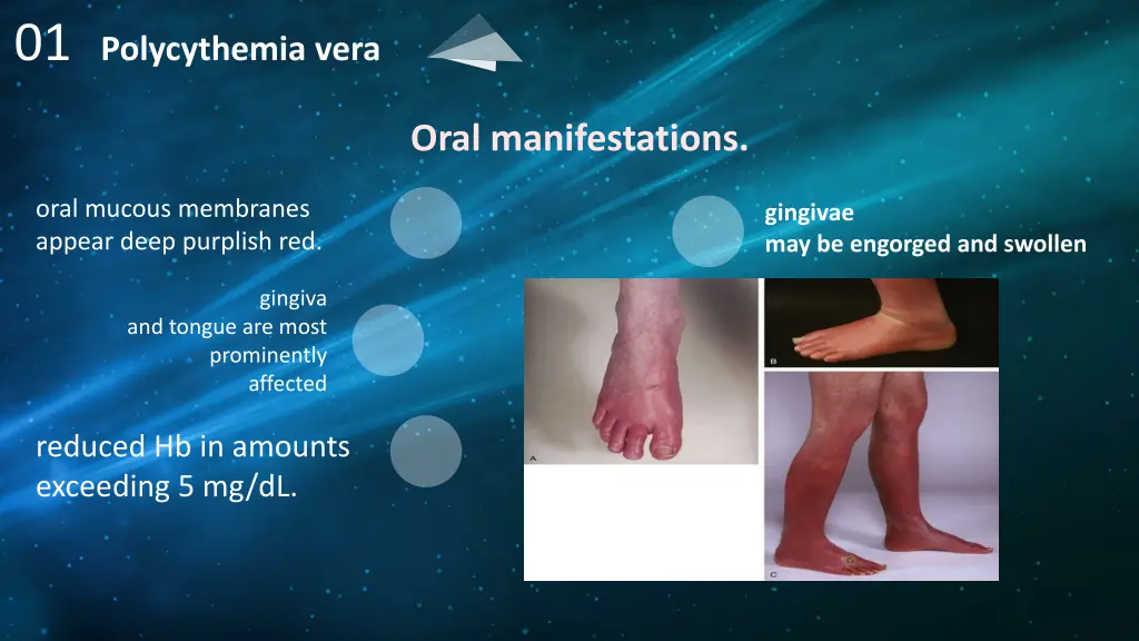 01 polycythemia vera