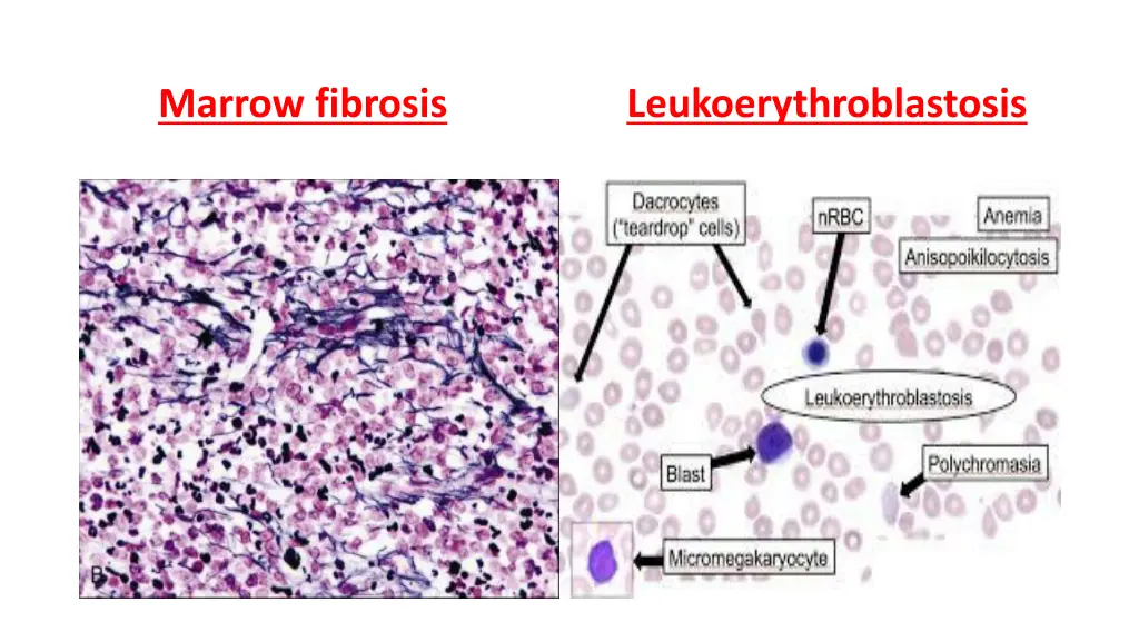 marrow fibrosis