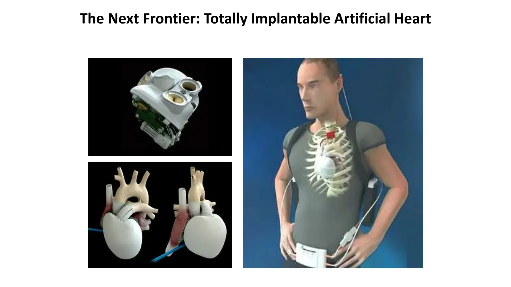 the next frontier totally implantable artificial
