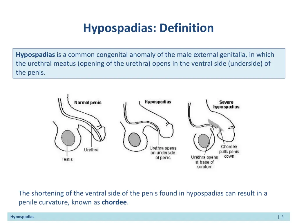 hypospadias definition