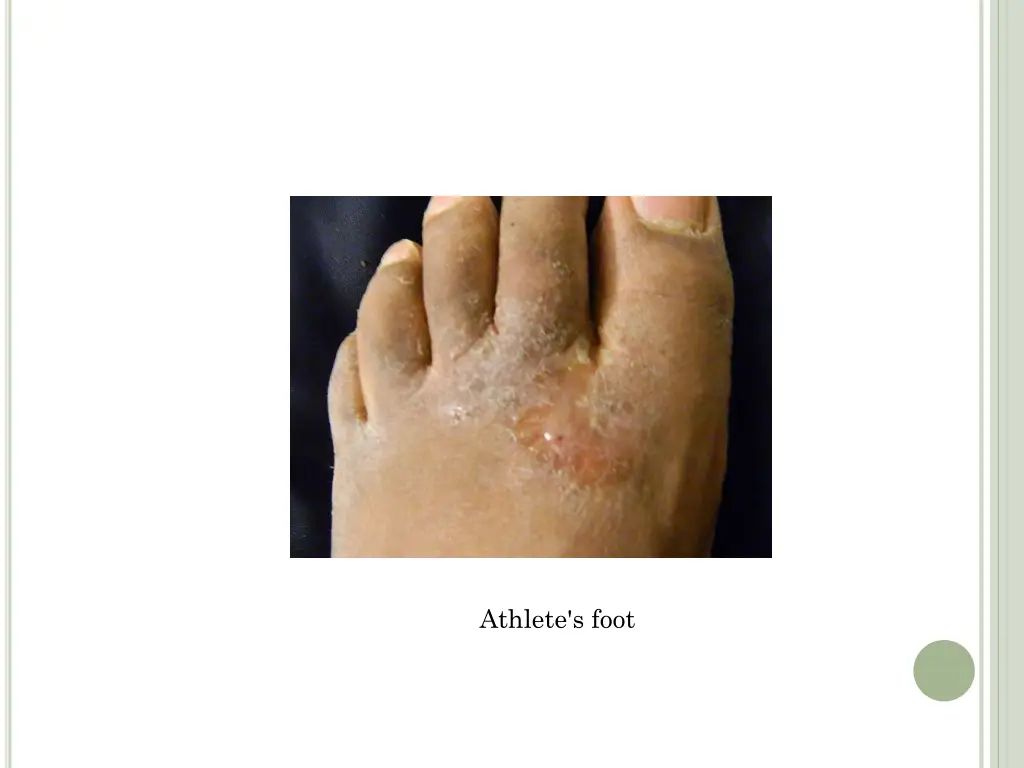 athlete s foot 1
