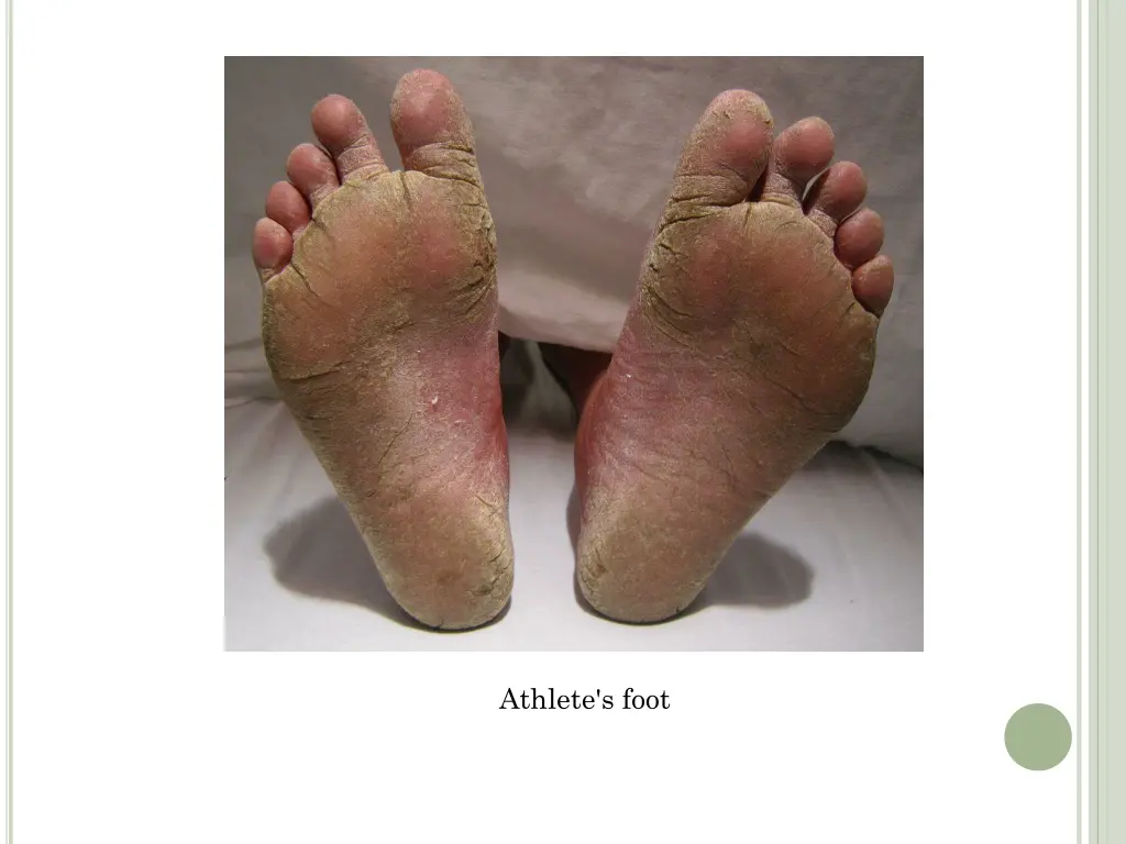 athlete s foot