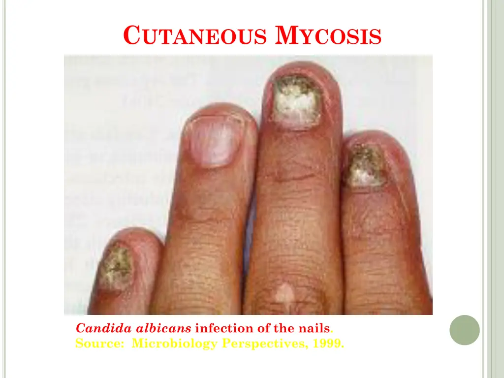 c utaneous m ycosis 1