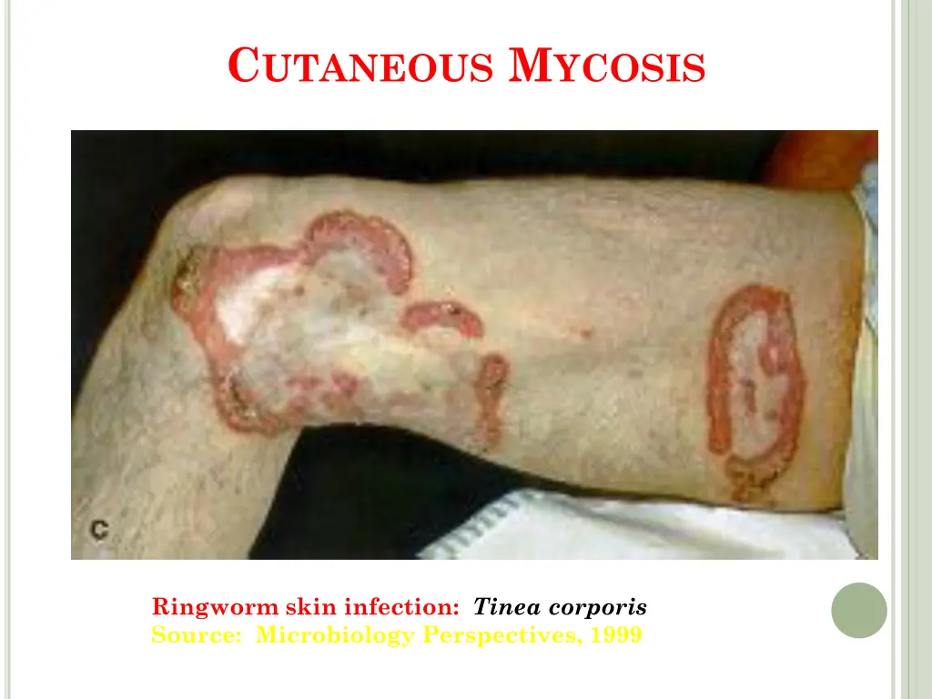c utaneous m ycosis