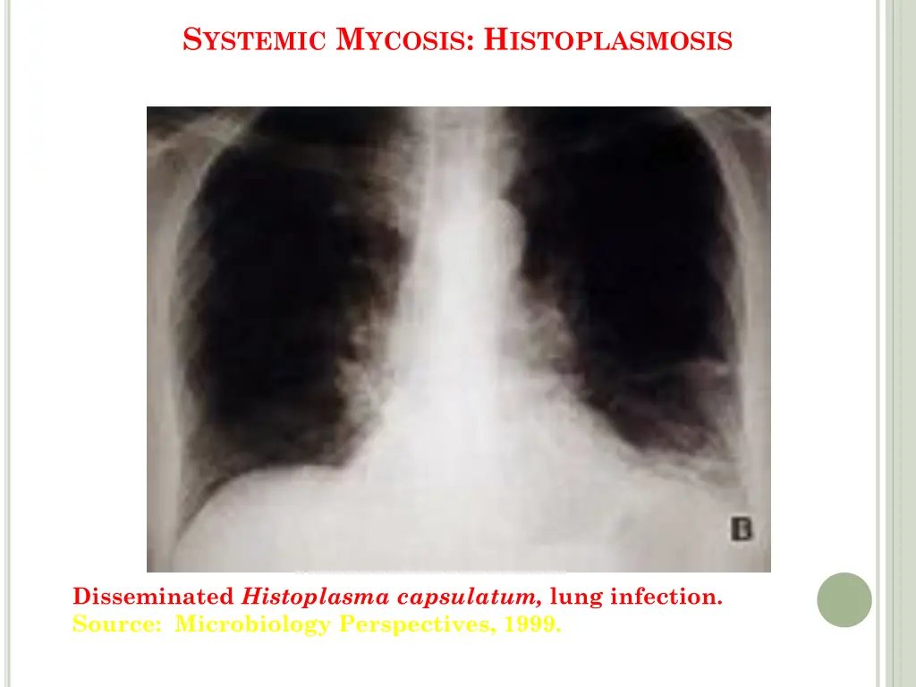s ystemic m ycosis h istoplasmosis