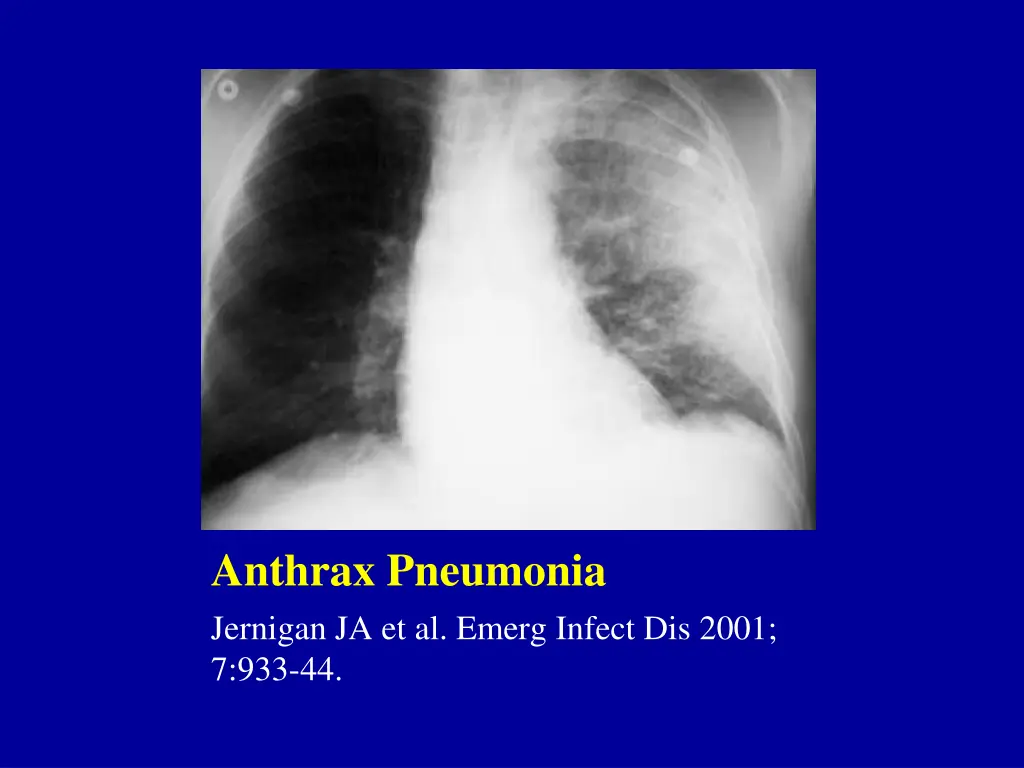 anthrax pneumonia jernigan ja et al emerg infect