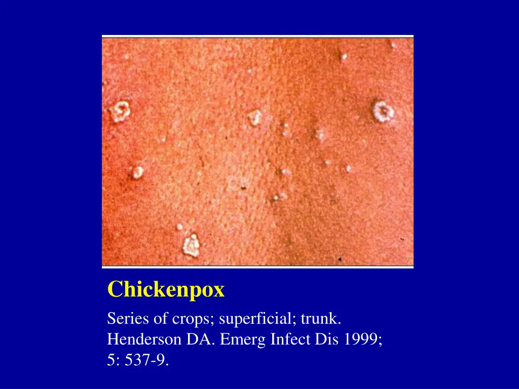 chickenpox series of crops superficial trunk